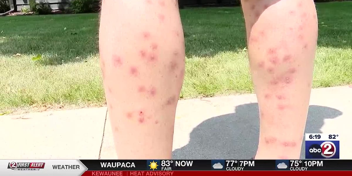 Swimmers Rash Lake Blue-green algae giving swimmers rashes in Lake Winnebago