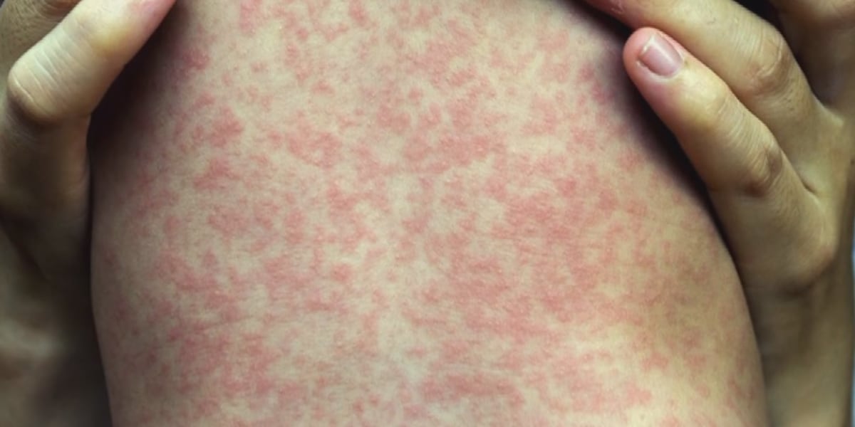 Vaccine exemptions among kindergartners hit record high, CDC data shows